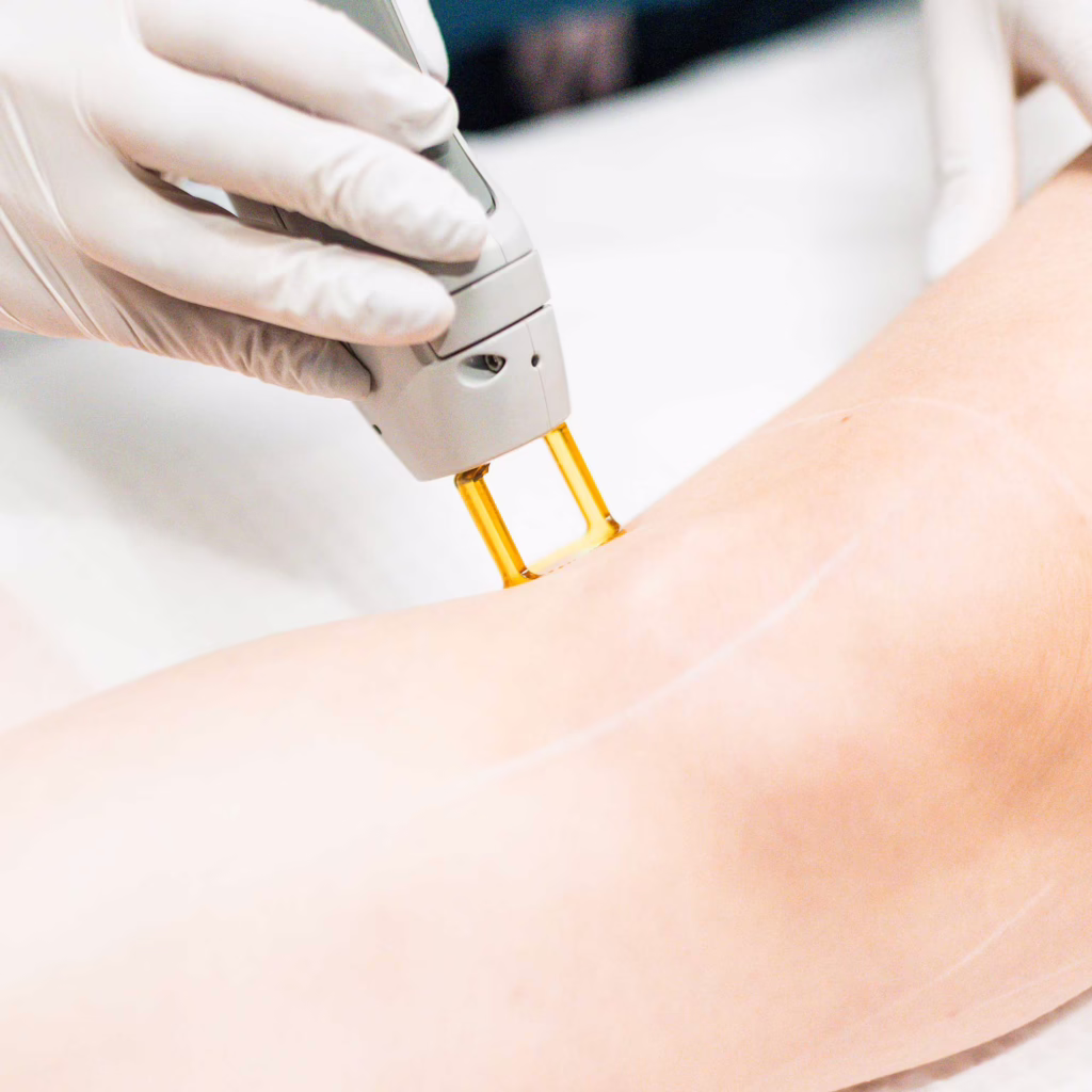 Laser Hair Removal Treatment