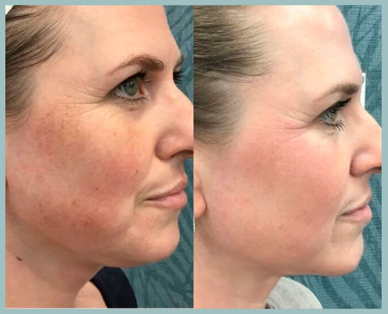 PRP Facial